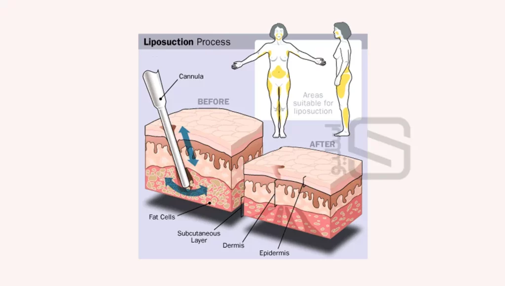 مراحل لیپوساکشن شکم