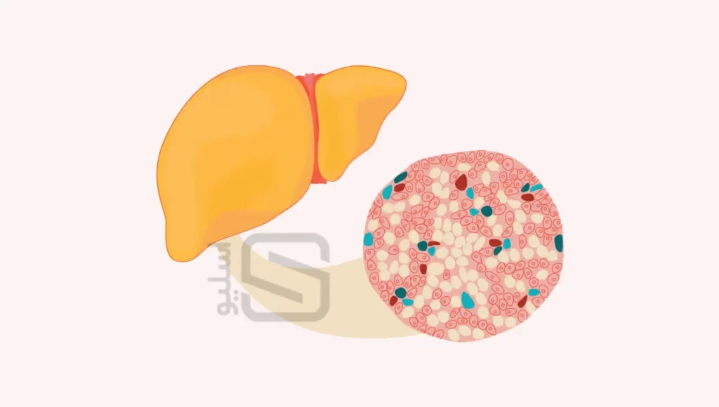 کبد چرب از مشکلات گوارشی