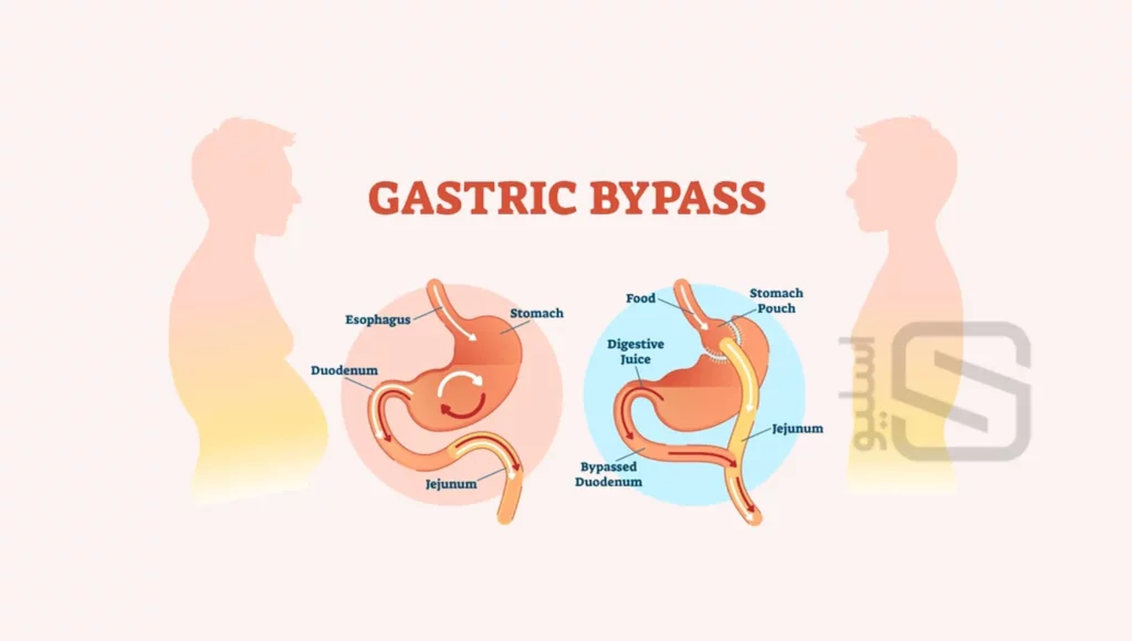 عکس شماتیک قبل و بعد از بای پس معده
