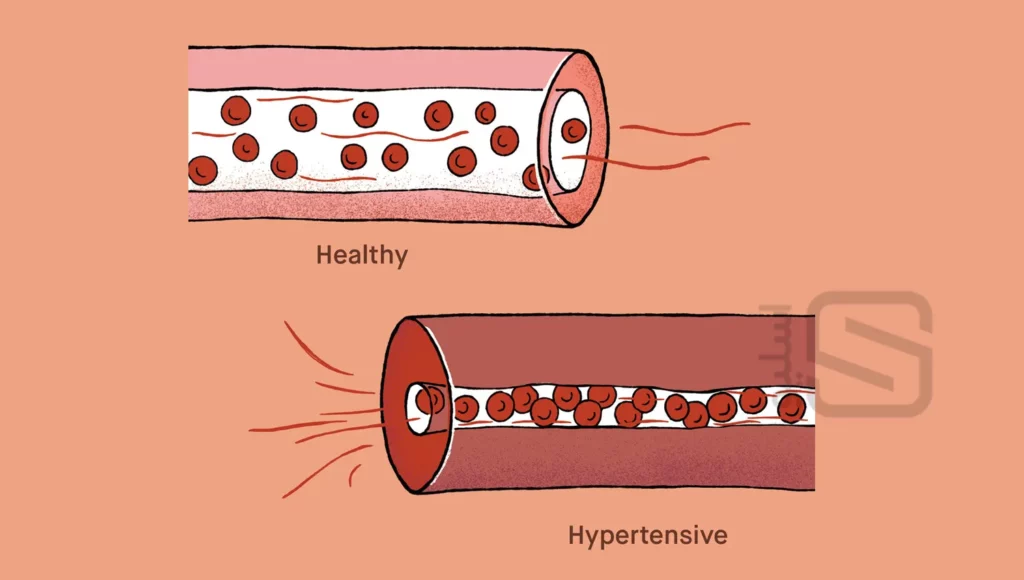 شماتیک فشار خون بالا