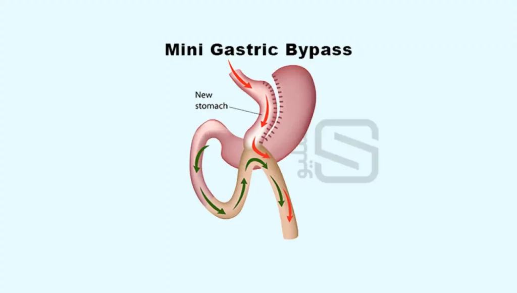 مینی بای پس معده