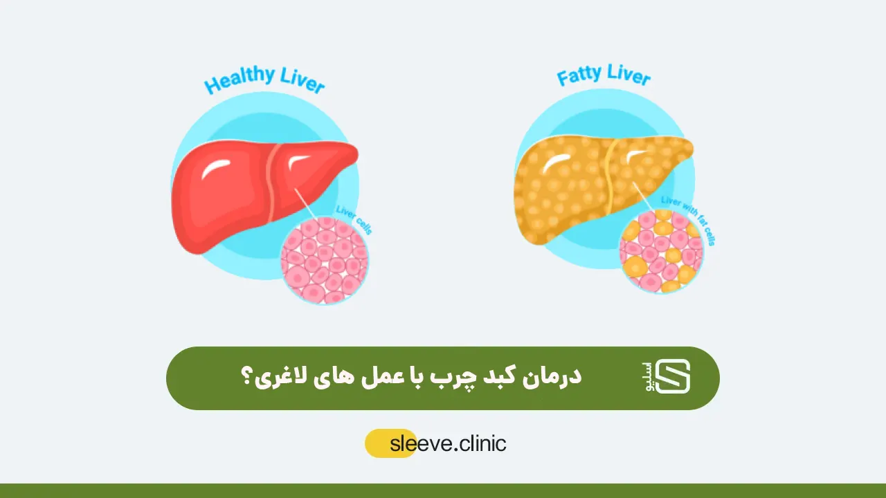 درمان کبد چرب با عمل لاغری