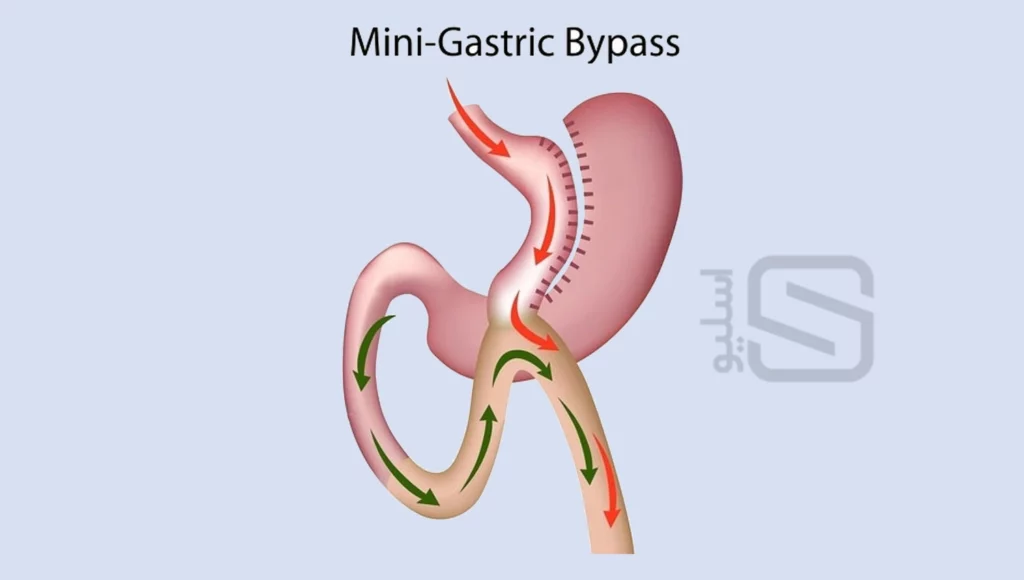 عکس شماتیک مینی بای پس معده