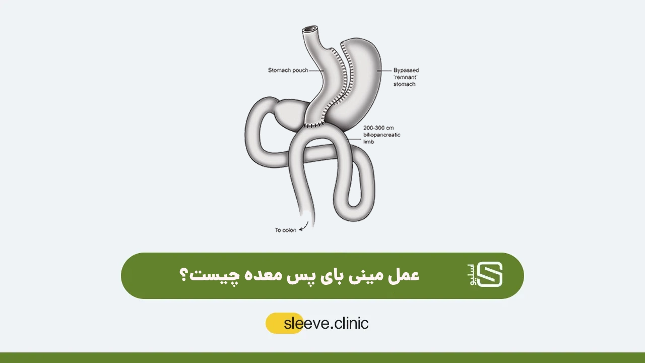 عمل مینی بای پس معده