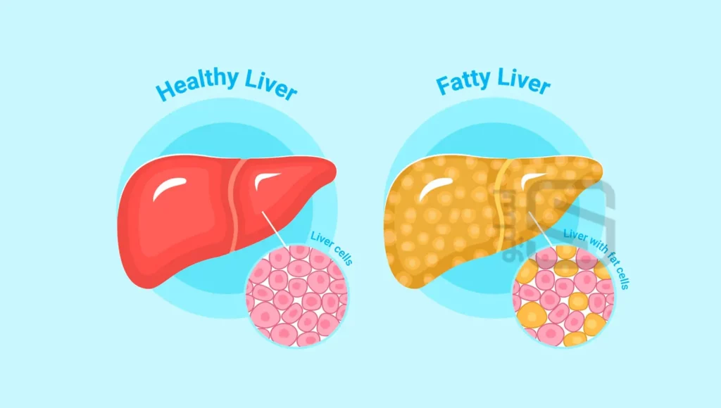 عکس کبد سالم و چرب